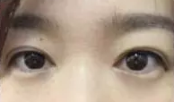 【整容日记】做了超声波双眼皮手术，恢复得很好了442