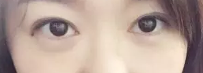 【整容日记】做了超声波双眼皮手术，恢复得很好了442