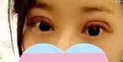 做超声波双眼皮手术恢复小记612 做超声波双眼皮手术恢复小记612