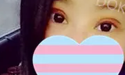 做超声波双眼皮手术恢复小记612 做超声波双眼皮手术恢复小记612