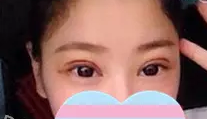做超声波双眼皮手术恢复小记612 做超声波双眼皮手术恢复小记612