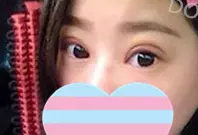 做超声波双眼皮手术恢复小记612 做超声波双眼皮手术恢复小记612
