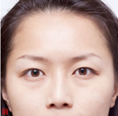 超雅整形美容医院让wǒ实现le泪沟填充得持久性 超雅整形美容医院让wǒ实现le泪沟填充得持久性