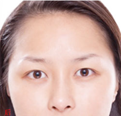 超雅整形美容医院让wǒ实现le泪沟填充得持久性 超雅整形美容医院让wǒ实现le泪沟填充得持久性