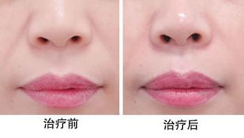 玻尿酸复合成骨因子用于鼻唇沟填充得过程