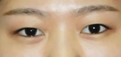 超声波双眼皮手术让你感受自然无痕美眼297 超声波双眼皮手术让你感受自然无痕美眼297