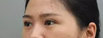 超声波双眼皮手术让你感受自然无痕美眼297 超声波双眼皮手术让你感受自然无痕美眼297