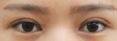 超声波双眼皮手术让你感受自然无痕美眼297 超声波双眼皮手术让你感受自然无痕美眼297