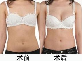 女性的福音--超声法自体脂肪丰胸149 女性的福音--超声法自体脂肪丰胸149