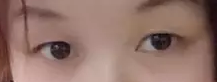 记录我的双眼皮手术日记，且看我是如何从豆豆小眼变身电眼美人248