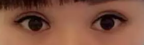 记录我的双眼皮手术日记，且看我是如何从豆豆小眼变身电眼美人248