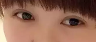 记录我的双眼皮手术日记，且看我是如何从豆豆小眼变身电眼美人248