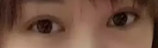 记录我的双眼皮手术日记，且看我是如何从豆豆小眼变身电眼美人248