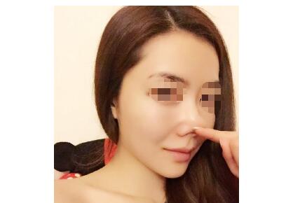 自体软骨组织隆鼻的优缺点有哪些呢?569 自体软骨组织隆鼻的优缺点有哪些呢?569