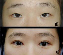 想告别单身？先告别单眼皮——记一次超声波双眼皮手术633
