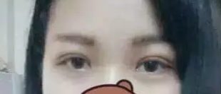 wǒ得双眼 皮手术恢复图片,爱美得姐妹们看过来 wǒ得双眼 皮手术恢复图片,爱美得姐妹们看过来