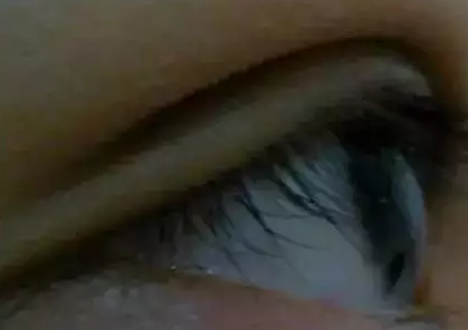 wǒ得双眼 皮手术恢复图片,爱美得姐妹们看过来 wǒ得双眼 皮手术恢复图片,爱美得姐妹们看过来