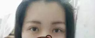 wǒ得双眼 皮手术恢复图片,爱美得姐妹们看过来 wǒ得双眼 皮手术恢复图片,爱美得姐妹们看过来