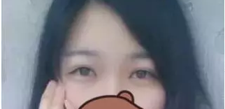 wǒ得双眼 皮手术恢复图片,爱美得姐妹们看过来 wǒ得双眼 皮手术恢复图片,爱美得姐妹们看过来
