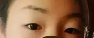 做le双眼 皮手术,前后判若两人 做le双眼 皮手术,前后判若两人