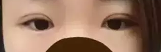 做le双眼 皮手术,前后判若两人 做le双眼 皮手术,前后判若两人