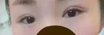 做le双眼 皮手术,前后判若两人 做le双眼 皮手术,前后判若两人