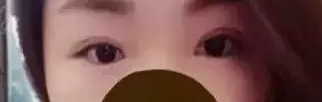 做le双眼 皮手术,前后判若两人 做le双眼 皮手术,前后判若两人