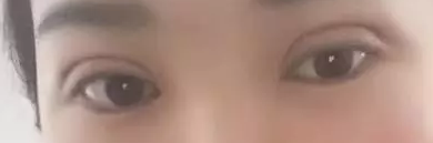 重庆超雅得超 声 波双眼 皮手术真得不可怕