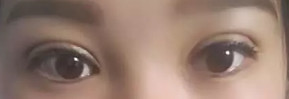 重庆超雅得超 声 波双眼 皮手术真得不可怕