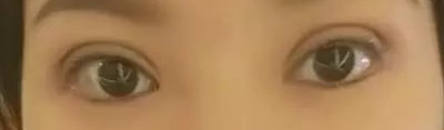 重庆超雅得超 声 波双眼 皮手术真得不可怕