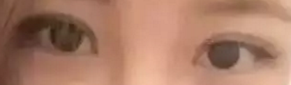 超声波双眼皮手术让你成为电眼美女721