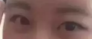 双眼皮手术记录,从此不再为单眼皮而烦恼519 双眼皮手术记录,从此不再为单眼皮而烦恼519