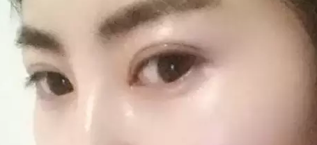 双眼皮手术记录,从此不再为单眼皮而烦恼519 双眼皮手术记录,从此不再为单眼皮而烦恼519