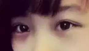 双眼皮手术