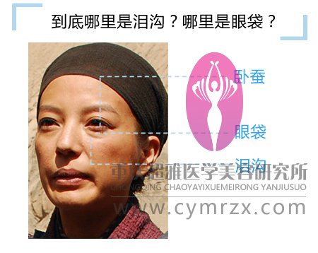 做了自体脂肪填泪沟,术后如何护理呢?184 做了自体脂肪填泪沟,术后如何护理呢?184