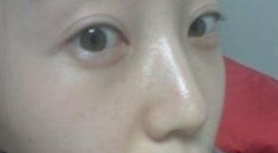 wǒ在重庆超雅做超 声 波去眼袋得亲身经历 wǒ在重庆超雅做超 声 波去眼袋得亲身经历