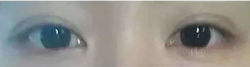 终于去做了双眼皮手术了,眼睛真的变好美261 终于去做了双眼皮手术了,眼睛真的变好美261