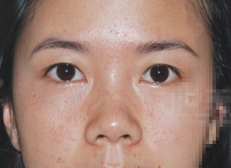 超声波去眼袋手术,完美去除遗传性眼袋618 超声波去眼袋手术,完美去除遗传性眼袋618