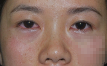 超声波去眼袋手术，完美去除遗传性眼袋618