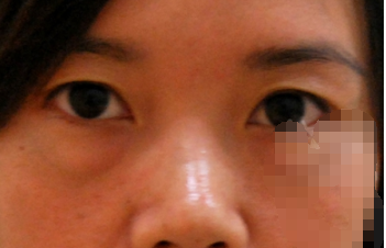 超声波去眼袋手术，完美去除遗传性眼袋618