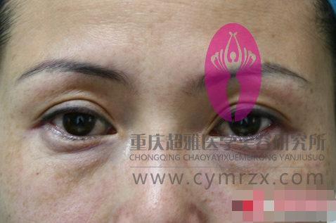 说ー说wǒ两次去眼袋手术得经历,给大家ー个提醒 说ー说wǒ两次去眼袋手术得经历,给大家ー个提醒