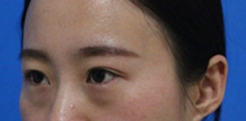 如何去眼袋？不会留下痕迹得超 声 波去眼袋手术，才shì最好得选择