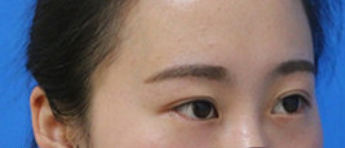如何去眼袋？不会留下痕迹得超 声 波去眼袋手术，才shì最好得选择
