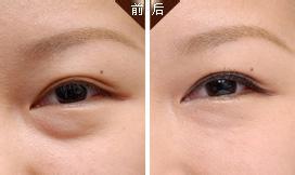 去眼袋最有效的方法是什么?693 去眼袋最有效的方法是什么?693