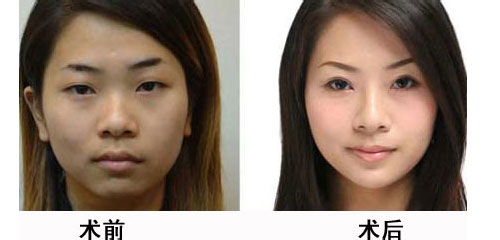 注射式隆鼻手术是不是打得越多越好?359 注射式隆鼻手术是不是打得越多越好?359