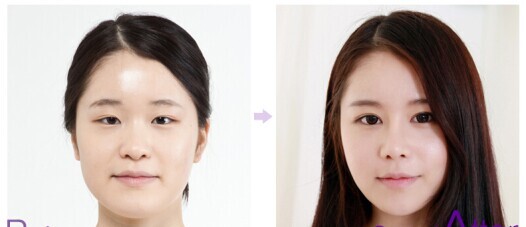 双眼 皮手术,wǒ选择超 声 波双眼 皮手术 双眼 皮手术,wǒ选择超 声 波双眼 皮手术