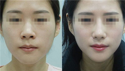 做le玻尿酸复合成骨因子隆鼻秒变美女 做le玻尿酸复合成骨因子隆鼻秒变美女