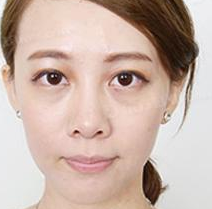 恢复超快的超声波去眼袋976 恢复超快的超声波去眼袋976