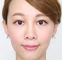 恢复超快的超声波去眼袋976 恢复超快的超声波去眼袋976