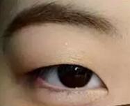 超声波双眼皮让我和单眼皮说拜拜859 超声波双眼皮让我和单眼皮说拜拜859